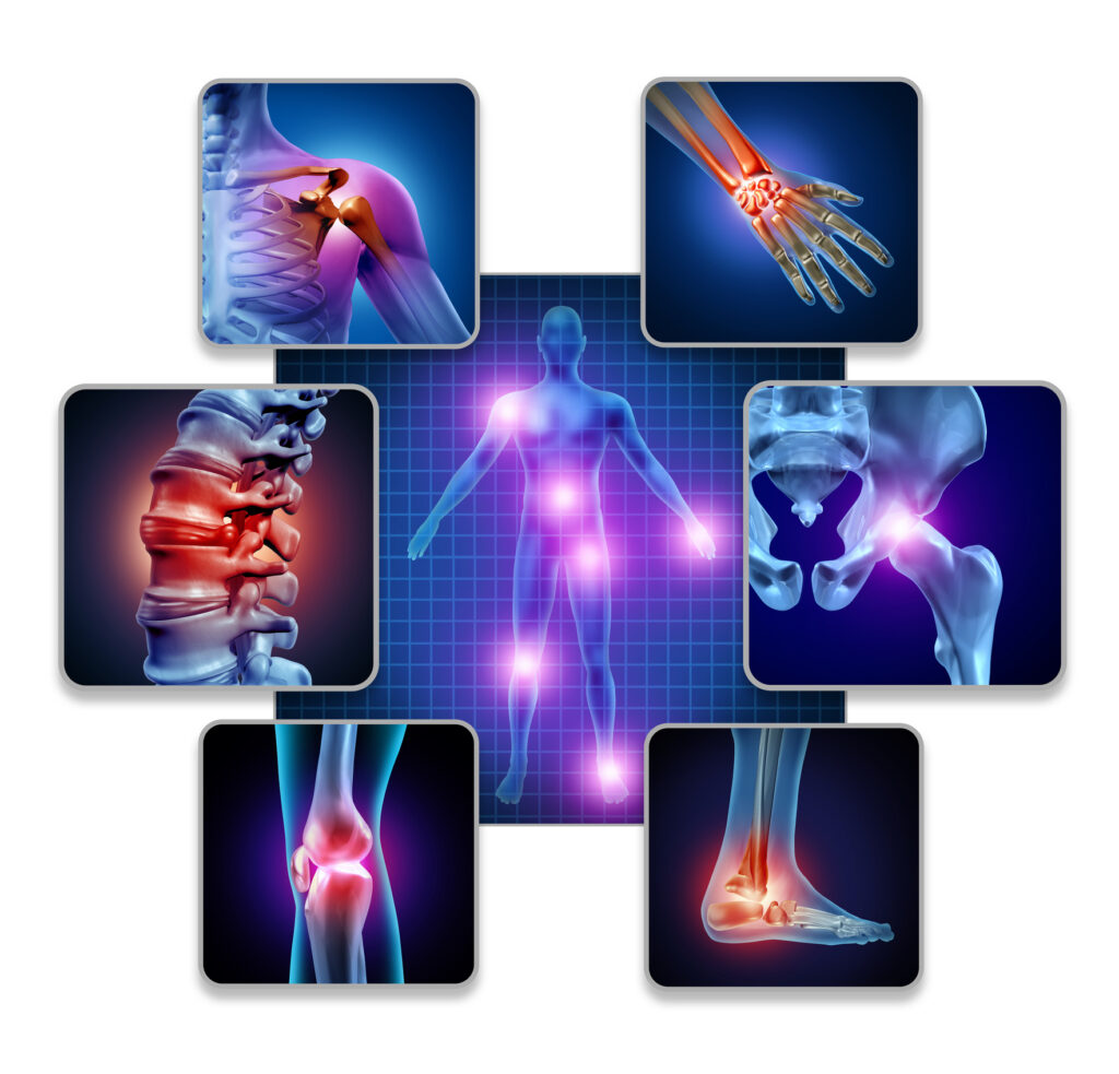 Illustration of joints affected by osteoarthritis, including the shoulder, hand, spine, hip, knee and ankle